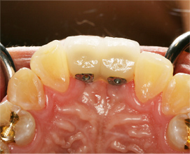 보철시스템 이미지1